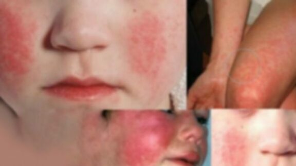 Carantină la o grădiniță din capitală